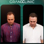 Результаты до и после DHI пересадки волос в Grand Clinic, видимое увеличение густоты