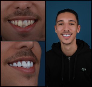 before-after photo installation-of-a-veneer