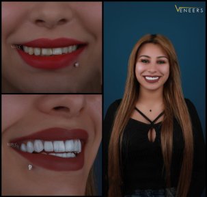 before-after photo installation-of-a-veneer
