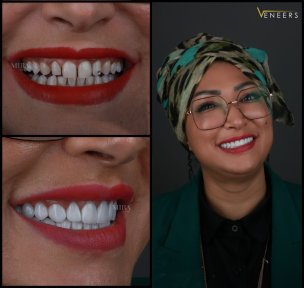 before-after photo installation-of-a-veneer