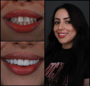 before-after photo installation-of-a-veneer
