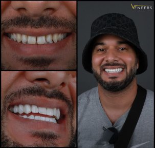 before-after photo installation-of-a-veneer