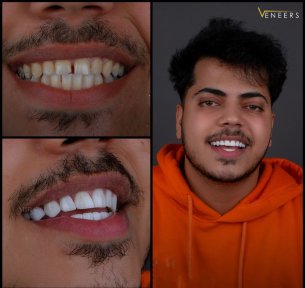 before-after photo installation-of-a-veneer