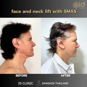 before-after photo rhinoplasty-nose-job