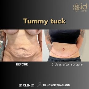 before-after photo abdominoplasty