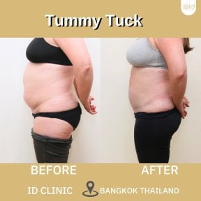before-after photo abdominoplasty