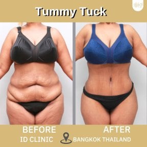 before-after photo abdominoplasty