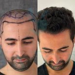 Результат до и после пересадки волос в Este Favor Hair Transplant Center, восстановленная линия