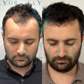 Результаты до и после пересадки волос в Este Favor Hair Transplant Center, улучшенная линия волос