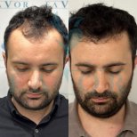 Результаты до и после пересадки волос в Este Favor Hair Transplant Center, улучшенная линия волос
