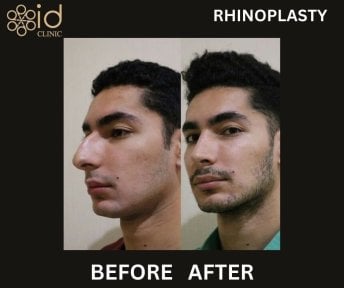 before-after photo rhinoplasty-nose-job