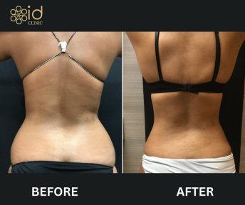 before-after photo liposuction