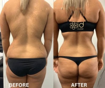 before-after photo liposuction