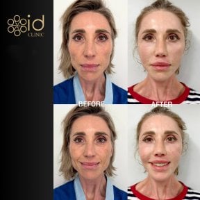 before-after photo rhinoplasty-nose-job
