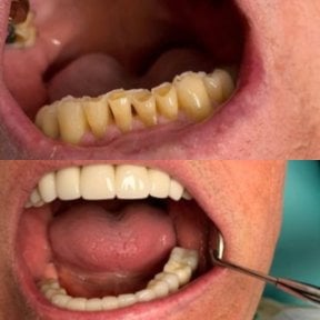 before-after photo dental-crown-installation