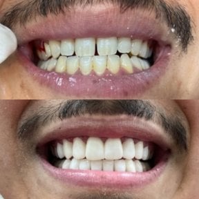 before-after photo dental-crown-installation