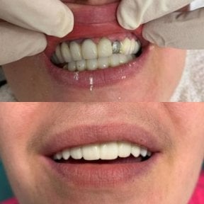 before-after photo dental-crown-installation
