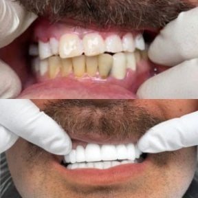 before-after photo dental-crown-installation
