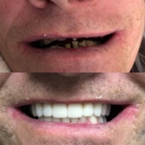 before-after photo dental-crown-installation