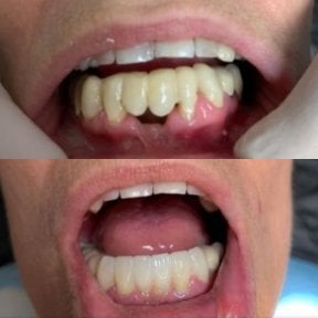 before-after photo dental-crown-installation