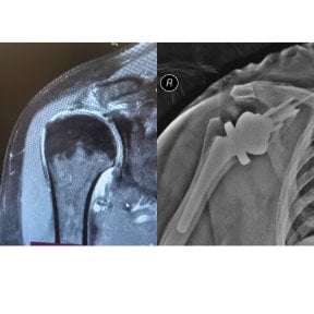 before-after photo shoulder-replacement