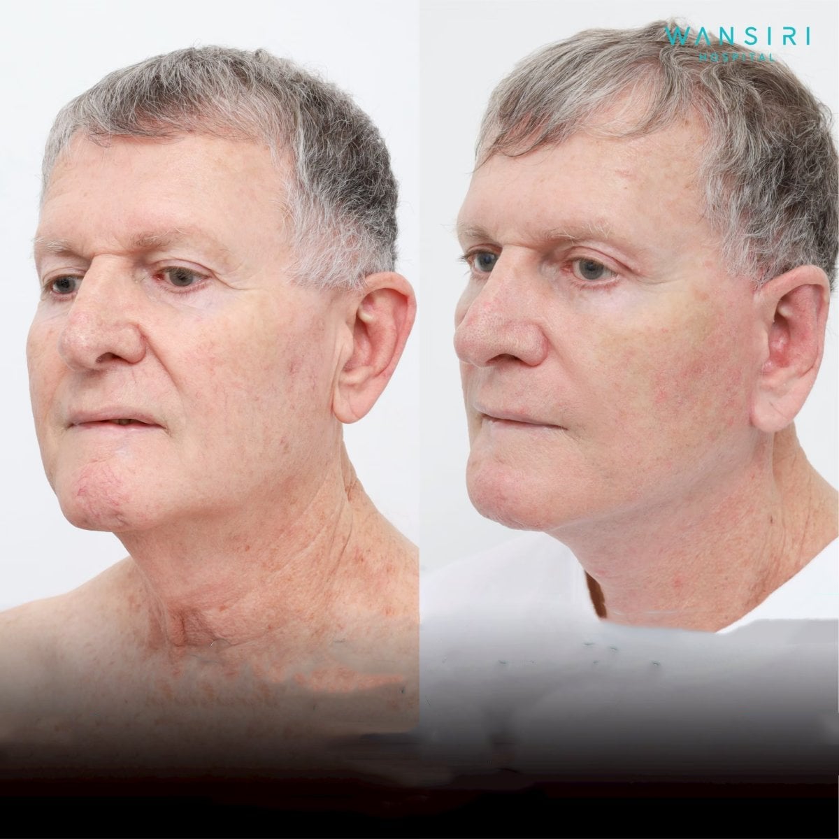 Resultados antes y después de lifting facial deep plane en Wansiri Hospital, rejuvenecimiento visible