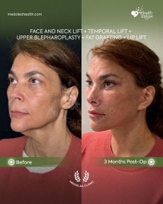 before-after photo glubokaya-podtyazhka-lica-deep-plane-facelift