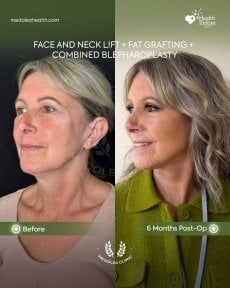 before-after photo glubokaya-podtyazhka-lica-deep-plane-facelift