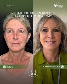 before-after photo glubokaya-podtyazhka-lica-deep-plane-facelift