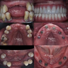 before-after photo dental-implant