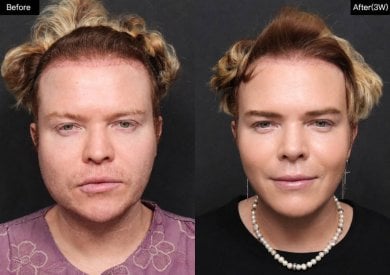 before-after photo breast-augmentation