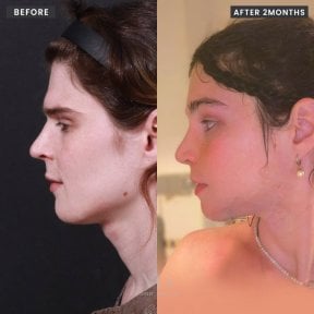 before-after photo breast-augmentation
