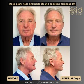 before-after photo tightening-of-facial-skin-facelift