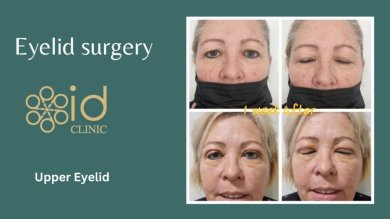 before-after photo lower-eyelid-surgery