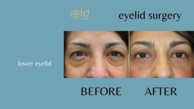before-after photo lower-eyelid-surgery