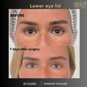 before-after photo lower-eyelid-surgery