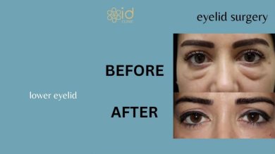 before-after photo lower-eyelid-surgery