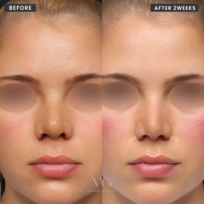 Vorher-nachher-Ergebnis der Nasenspitzenkorrektur bei VG Plastic Surgery nach 2 Wochen