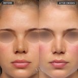 Vorher-nachher-Ergebnis der Nasenspitzenkorrektur bei VG Plastic Surgery nach 2 Wochen