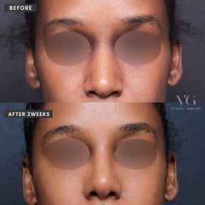 Vorher-nachher-Ergebnis der Spitzenrhinoplastik bei VG Plastic Surgery nach 2 Wochen