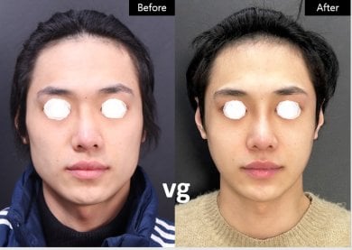 before-after photo tip-rhinoplasty