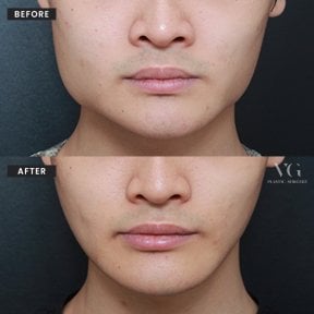 before-after photo tip-rhinoplasty