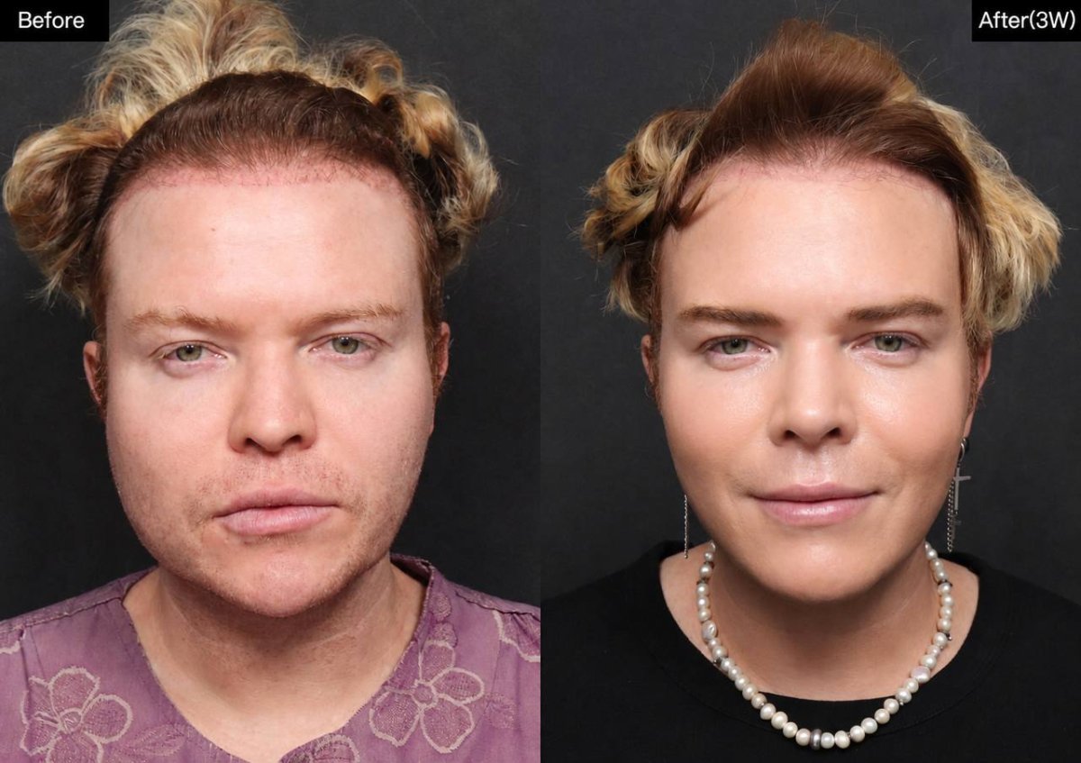 Resultados antes y después de rinoplastia de punta en VG Plastic Surgery, mejor forma nasal