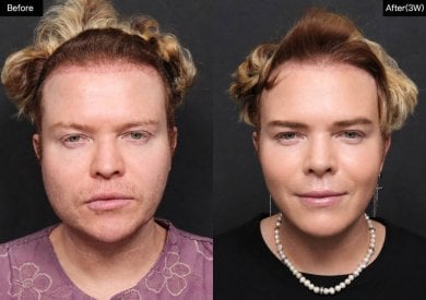 before-after photo tip-rhinoplasty