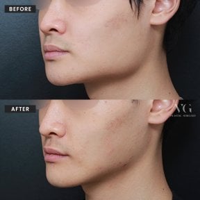 before-after photo tip-rhinoplasty