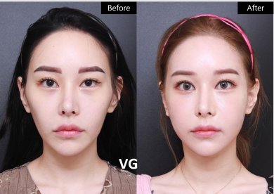 before-after photo tip-rhinoplasty