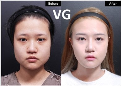 before-after photo tip-rhinoplasty
