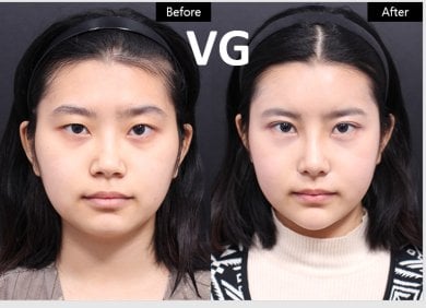 before-after photo tip-rhinoplasty