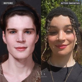 before-after photo tip-rhinoplasty