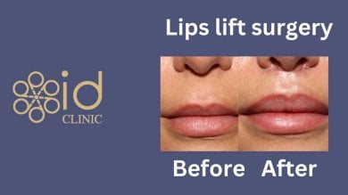 before-after photo rhinoplasty-nose-job